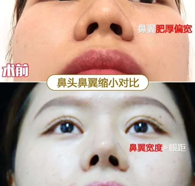 盘点！鼻整形术后会留下哪些疤痕？介意者需注意(图1)